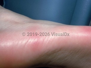 Palmar-plantar eccrine hidradenitis