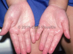 Clinical image of Hyperhidrosis - imageId=2037056. Click to open in gallery.  caption: 'Glistening of the palms and fingers secondary to hyperhidrosis.'