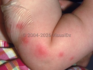Papular urticaria