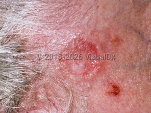 Nodular basal cell carcinoma