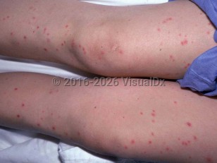 Trichosporon sepsis