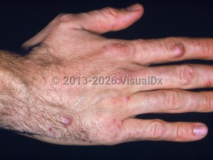 Clinical image of Sea urchin sting - imageId=2054859. Click to open in gallery. 