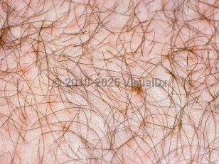 Clinical image of Pediculosis pubis - imageId=2074754. Click to open in gallery.  caption: 'Pubic lice and nits attached to pubic hair shafts.'