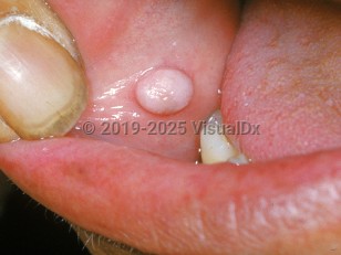 Oral fibroma
