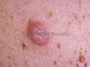 Pseudolymphoma
