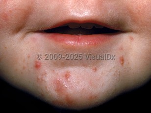 Clinical image of Infantile acne - imageId=2102454. Click to open in gallery.  caption: 'Erythematous acneiform papules and open comedones on the chin of an infant.'
