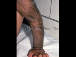 Clinical image of Congenital hypertrichosis lanuginosa - imageId=2110784. Click to open in gallery.  caption: 'Diffuse downy hair growth on the arm.'