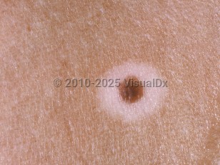 Clinical image of Halo nevus - imageId=211205. Click to open in gallery.  caption: 'A close-up of a brown papule with a surrounding depigmented halo.'