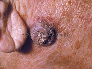 Keratoacanthoma