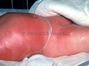 Staphylococcal scalded skin syndrome