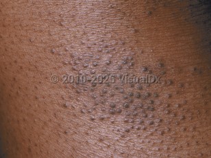 Atopic dermatitis
