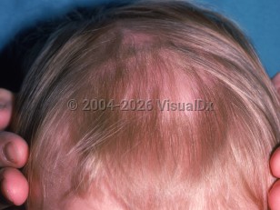 Telogen effluvium