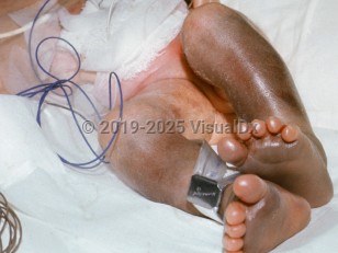 Clinical image of Breech baby injury - imageId=2163890. Click to open in gallery.  caption: '<span>Bruised legs resulting from double footing breech in premature infant.</span>'