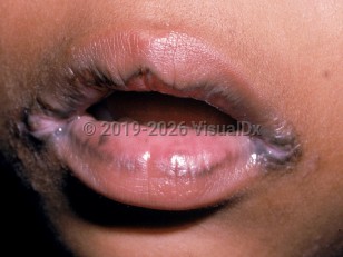 Angular cheilitis