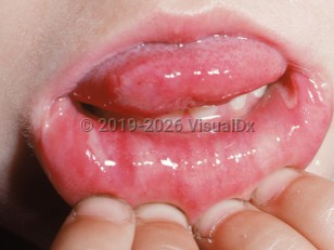 Aphthous stomatitis