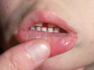 Oral mucocele