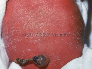 Clinical image of Postmaturity desquamation - imageId=2180208. Click to open in gallery.  caption: 'Diffuse erythema with superficial peeling scale on the abdomen of a newborn.'