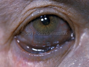 Argyria