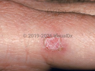 Iododerma