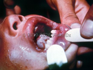 Endemic syphilis
