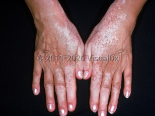 Clinical image of Drug-induced hypopigmentation - imageId=2200832. Click to open in gallery.  caption: 'Depigmented macules and patches on the dorsal hands, secondary to monobenzone applied to the face.'