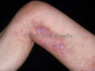 Drug-induced skin ulcers