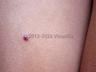 South American bartonellosis