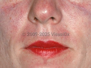 Clinical image of Carcinoid syndrome - imageId=2219774. Click to open in gallery.  caption: 'Red and lightly violaceous patches on the central face.'