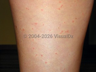 West Nile virus