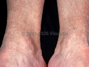 Acrokeratosis verruciformis
