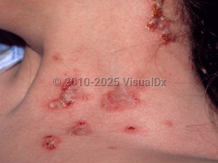 Pemphigus vegetans