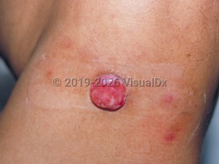 Merkel cell carcinoma