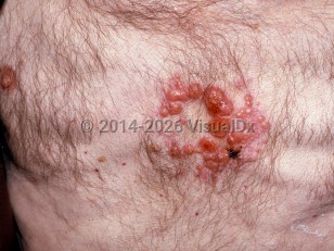 Clinical image of Metastatic cutaneous carcinoma - imageId=227875. Click to open in gallery.  caption: 'A cluster of shiny reddish papules and nodules on the central chest.'