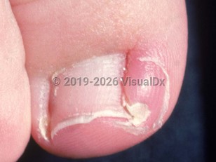 Ingrown toenail