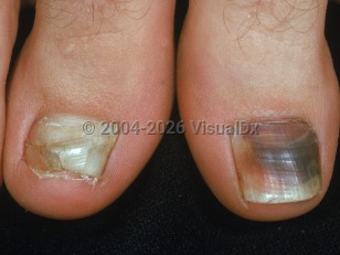 Subungual hematoma