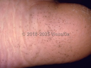 Clinical image of Pitted keratolysis - imageId=230692. Click to open in gallery.  caption: 'Multiple tiny keratin pits on the heel.'