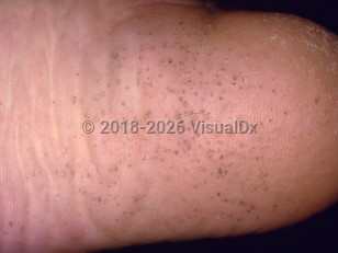 Pitted keratolysis