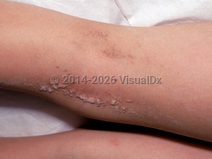 Keratinocytic epidermal nevus