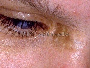 Clinical image of Homocystinuria - imageId=231225. Click to open in gallery.  caption: 'Pigmentary dilution of skin and blue eye color.'
