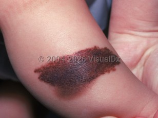 Clinical image of Congenital melanocytic nevus - imageId=2314374. Click to open in gallery.  caption: 'A large variegated, reddish, and brown plaque on the leg.'