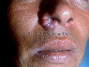 Rhinoscleroma
