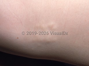 Buschke-Ollendorff syndrome