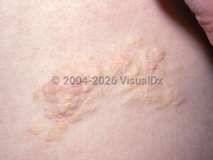 Clinical image of Nevus lipomatosus superficialis - imageId=2331235. Click to open in gallery.  caption: 'A close-up of a cluster of yellowish and light pink papules, plaques, and nodules.'