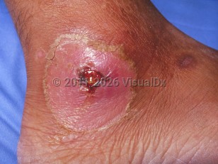 Cutaneous diphtheria