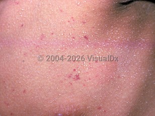 Miliaria crystallina