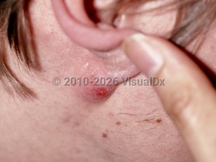 Clinical image of Carbuncle - imageId=235068. Click to open in gallery.  caption: 'A pink nodule with a central crust behind the ear.'