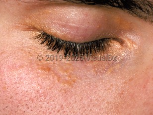 Xanthelasma palpebrarum
