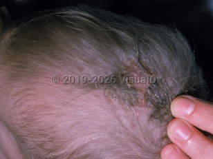 Hyperimmunoglobulinemia E syndrome