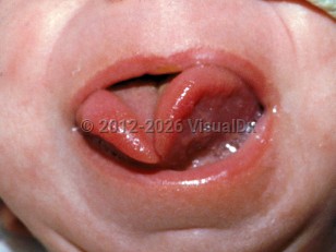 Clinical image of Beckwith-Wiedemann syndrome - imageId=2377060. Click to open in gallery.  caption: 'Macroglossia and a bifid tongue.'