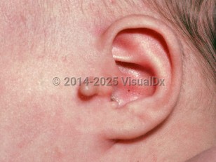 Accessory tragus